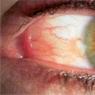 Что такое птеригиум глаза и как его лечить?