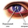 Какие анализы нужно сдать для операции катаракты?