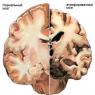 Церебральная атрофия мозга головы, возможная продолжительность жизни Атрофия мозга и жизнь ребенка